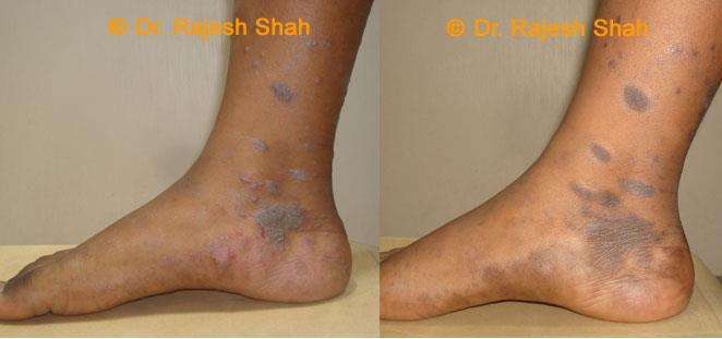 Lichen Planus Before and After Case Photo