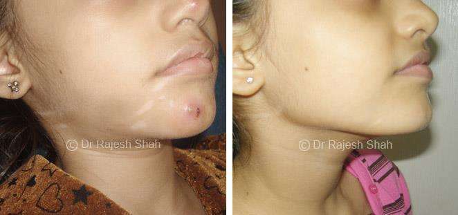 Vitiligo Before and After Case Photo