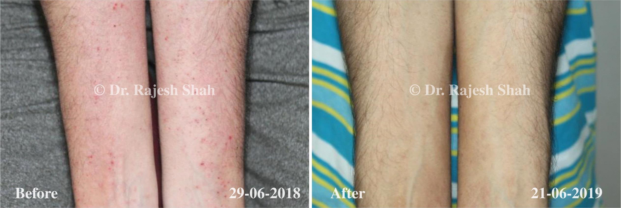 Atopic Dermatitis Before and After Case Photo