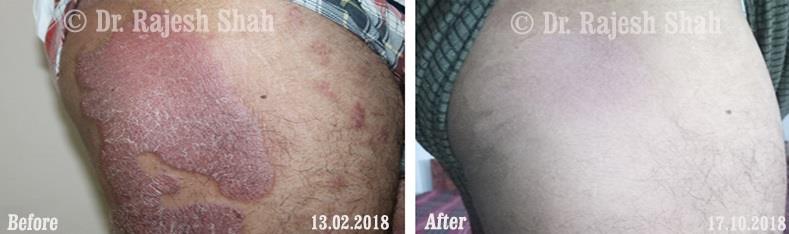 Psoriasis Before and After Case Photo