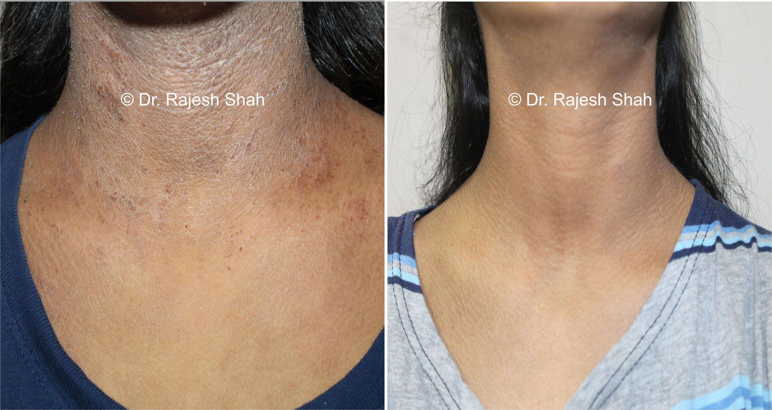 Atopic Dermatitis Before and After Case Photo