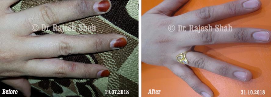 Eczema Before and After Case Photo