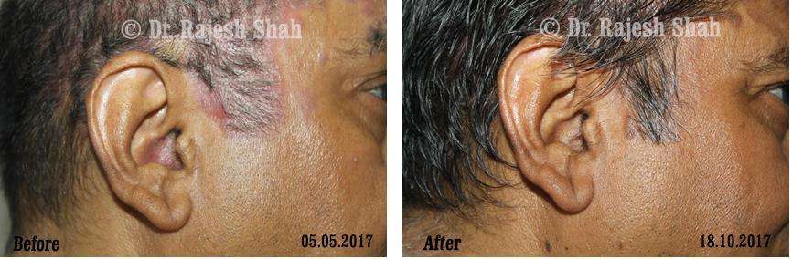 Psoriasis Before and After Case Photo