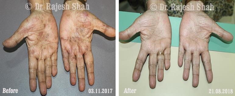 Atopic Dermatitis Before and After Case Photo