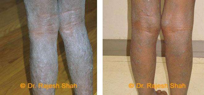 Eczema Before and After Case Photo