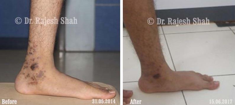 Lichen Planus Before and After Case Photo