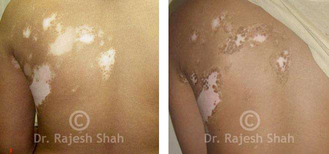 Vitiligo