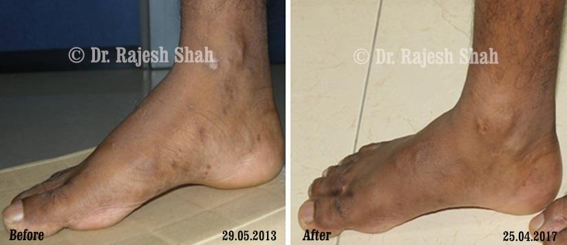 Lichen Planus Before and After Case Photo