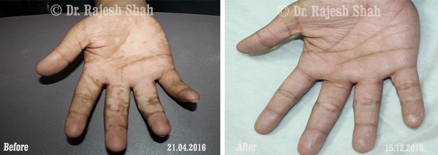 Vitiligo Before and After Case Photo