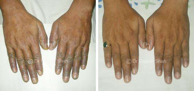 Psoriasis Before and After Case Photo