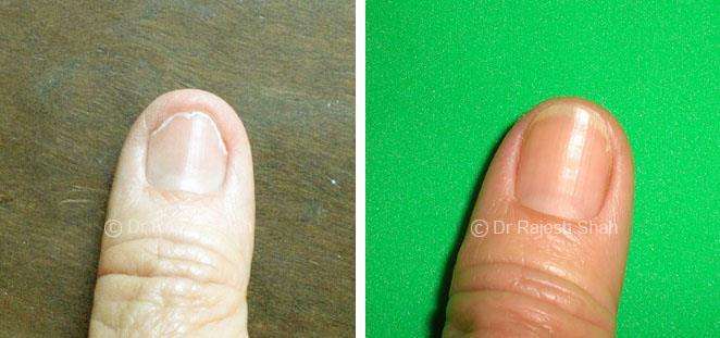 Lichen Planus Before and After Case Photo