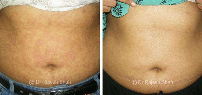 Psoriasis Before and After Case Photo