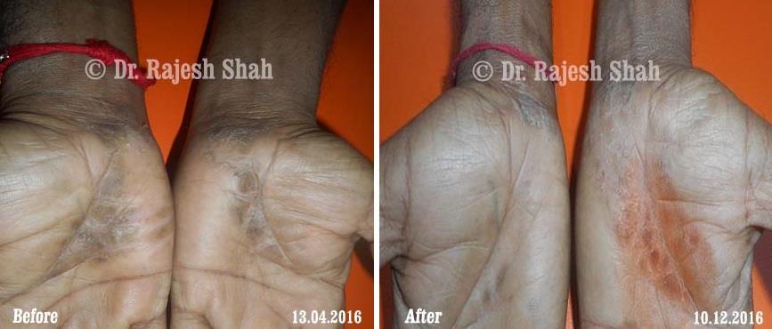 Psoriasis Before and After Case Photo