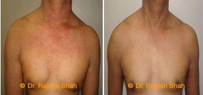 Eczema Before and After Case Photo