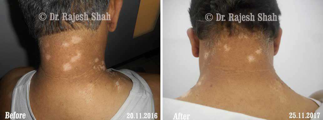 Vitiligo Before and After Case Photo