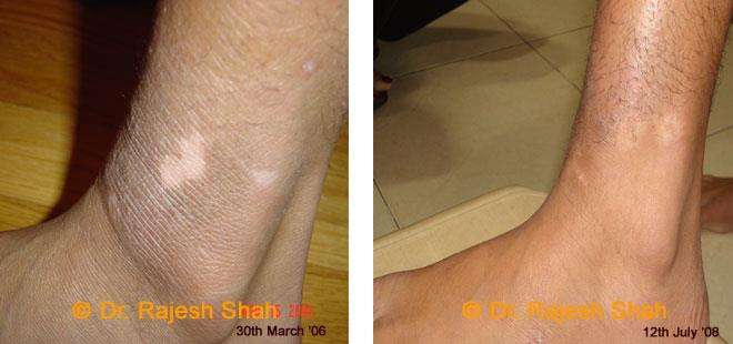 Vitiligo Before and After Case Photo
