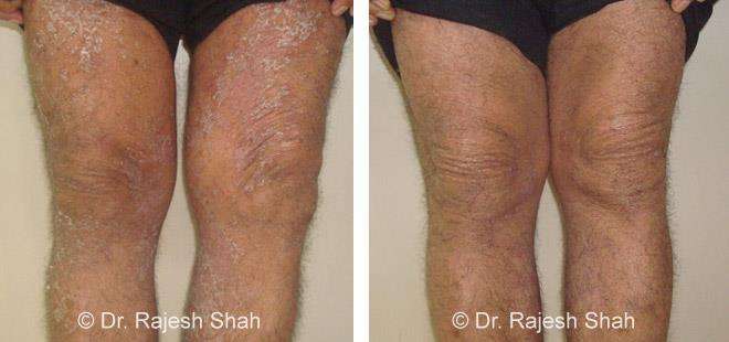Psoriasis Before and After Case Photo