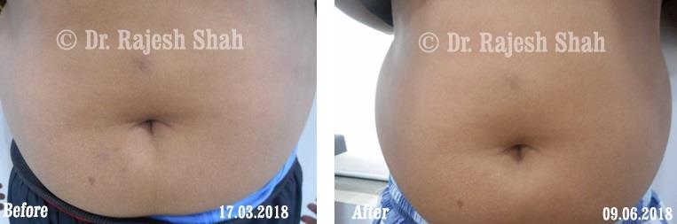 Alopecia Areata Before and After Case Photo