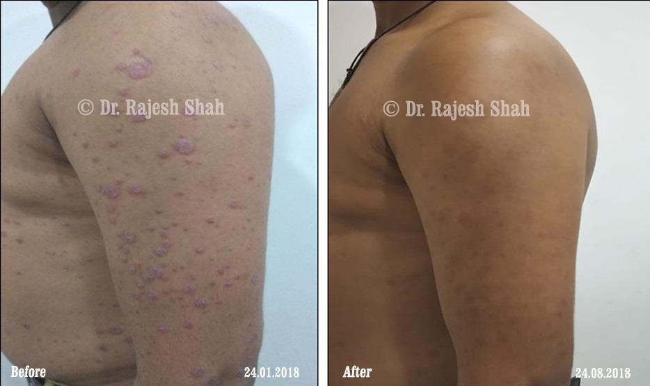 Psoriasis Before and After Case Photo