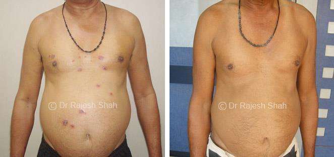 Psoriasis Before and After Case Photo