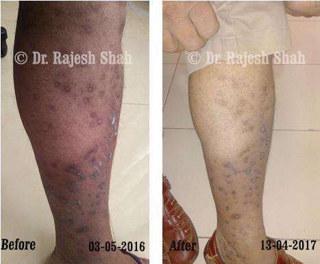 Psoriasis Before and After Case Photo
