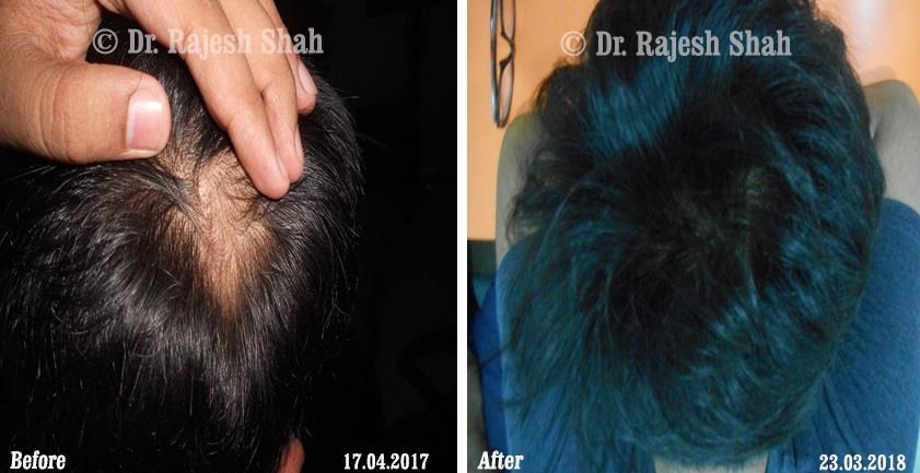 Alopecia Areata Before and After Case Photo
