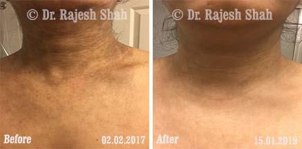 Lichen Planus Pigmentosa Before and After Case Photo