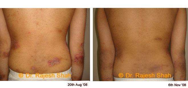 Eczema Before and After Case Photo