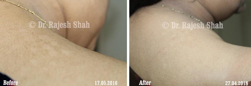 Pityriasis Versicolor Before and After Case Photo