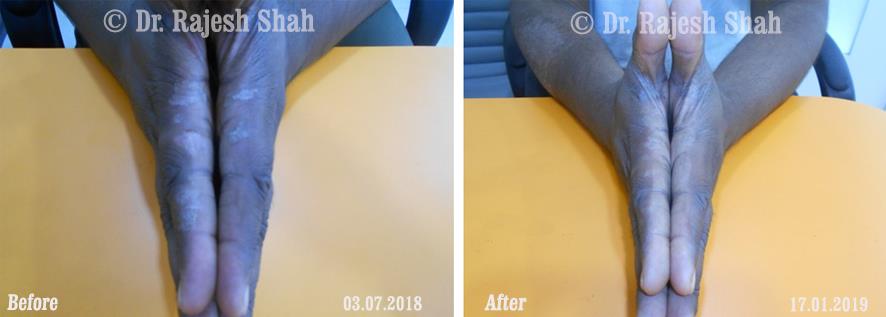 Psoriasis Before and After Case Photo