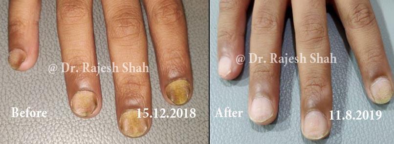 Psoriasis Before and After Case Photo