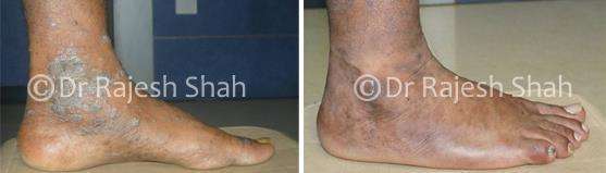 Lichen Planus Before and After Case Photo