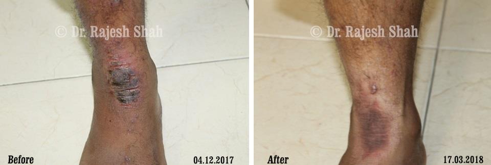 Eczema Before and After Case Photo