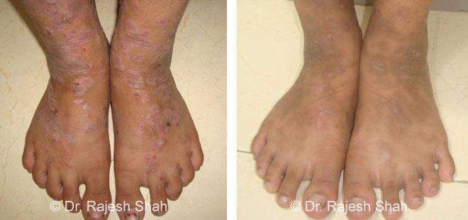 Lichen Planus Before and After Case Photo