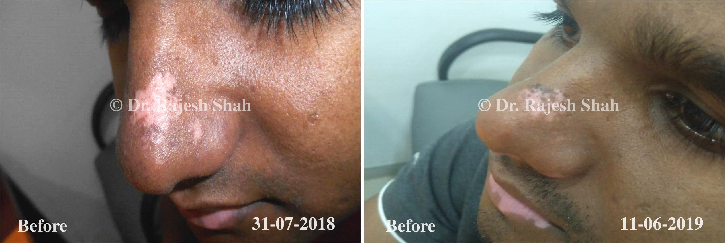 Vitiligo Before and After Case Photo