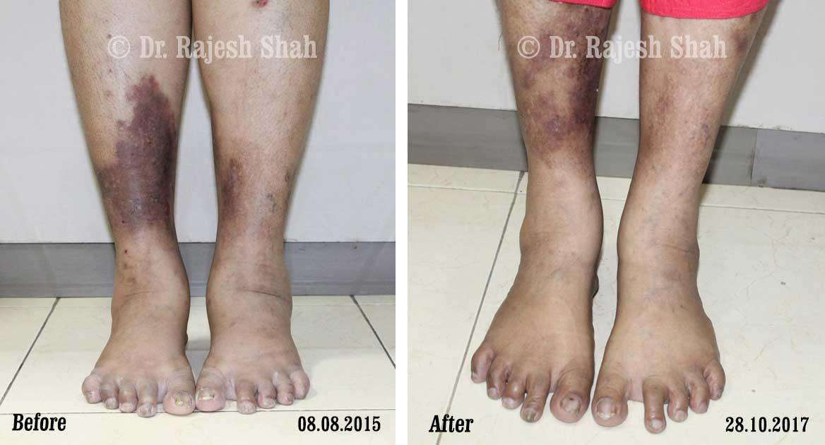 Psoriasis Before and After Case Photo