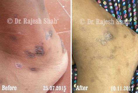 Lichen Planus Before and After Case Photo