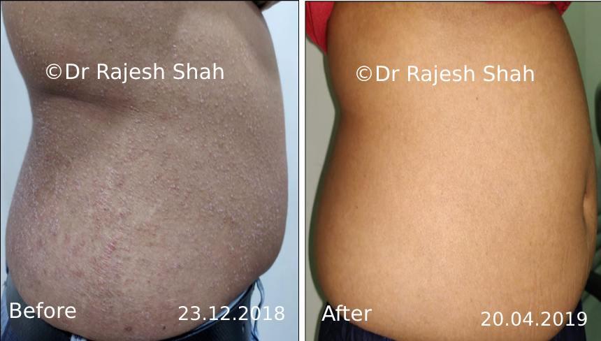 Psoriasis Before and After Case Photo