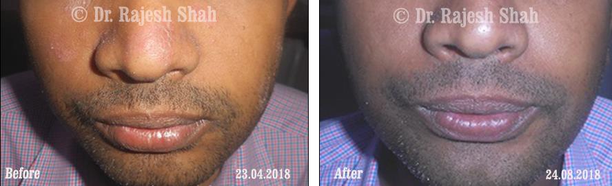 Psoriasis Before and After Case Photo