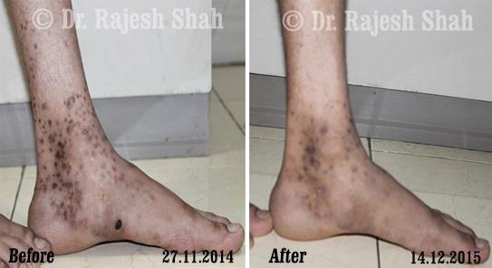Lichen Planus Before and After Case Photo