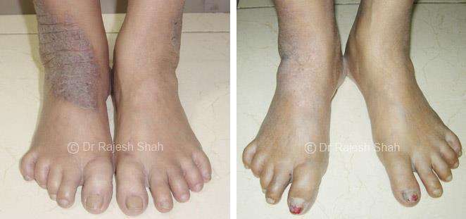 Psoriasis Before and After Case Photo