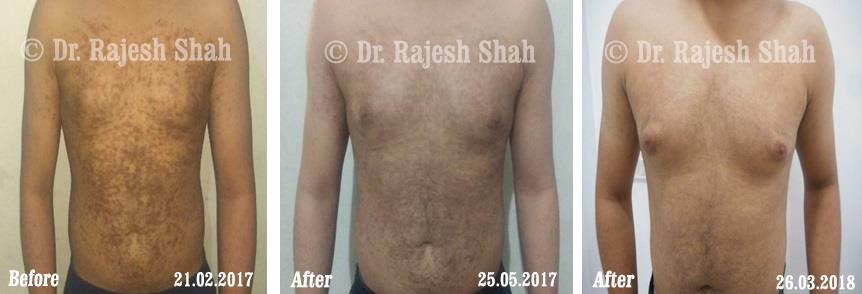 Lichen Planus Before and After Case Photo