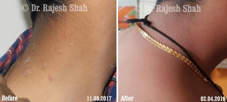 Lichen Planus Before and After Case Photo