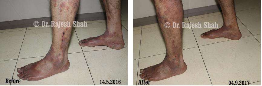 Atopic Dermatitis Before and After Case Photo