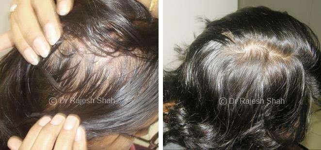 Alopecia Areata Before and After Case Photo