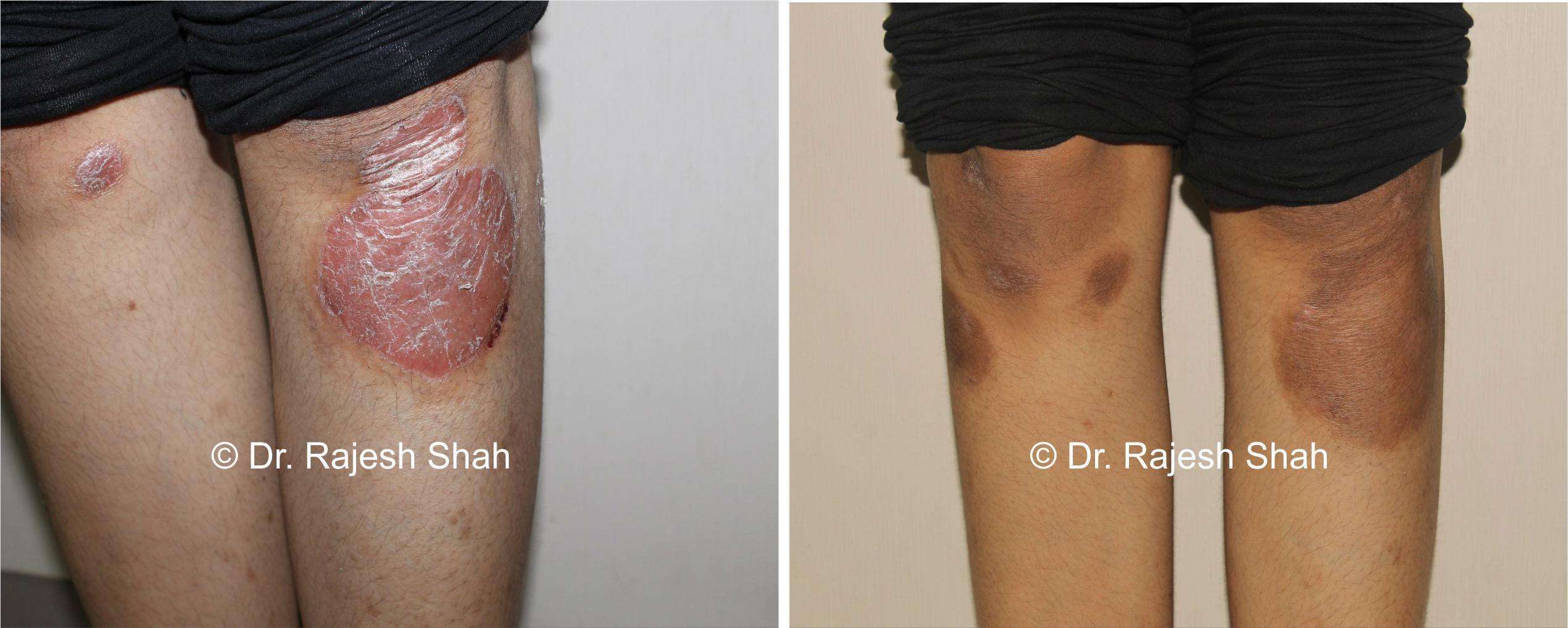 Psoriasis Before and After Case Photo