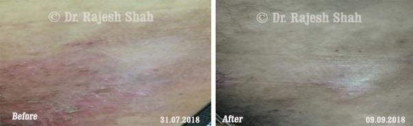 Psoriasis Before and After Case Photo