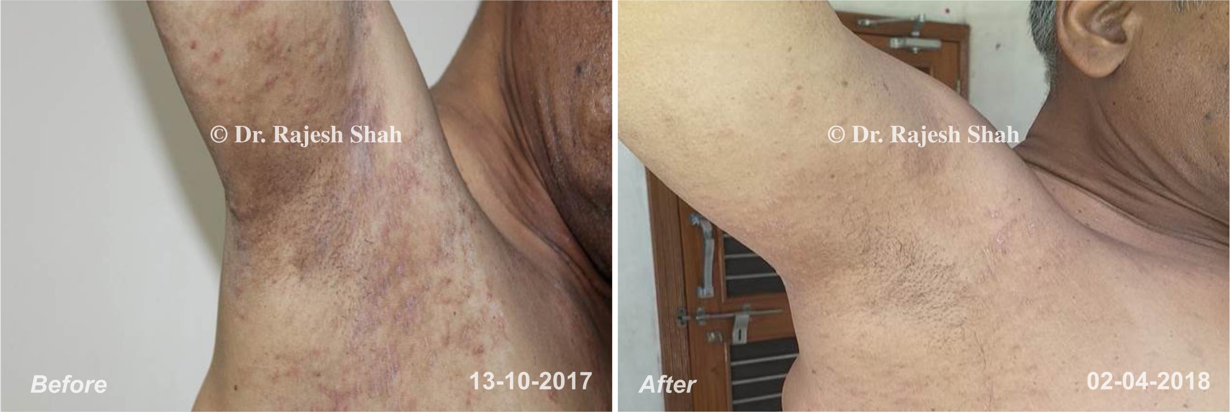 Psoriasis Before and After Case Photo