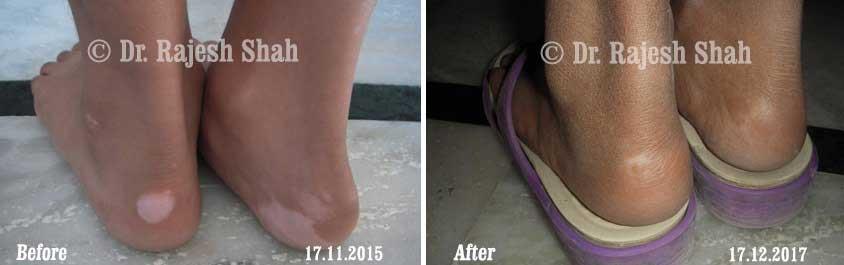 Vitiligo Before and After Case Photo