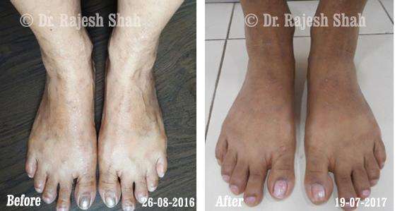 Lichen Planus Before and After Case Photo